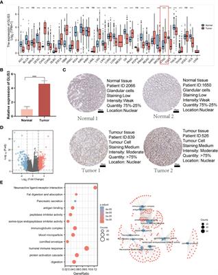 The gene regulatory molecule GLIS3 in gastric cancer as a prognostic marker and be involved in the immune infiltration mechanism